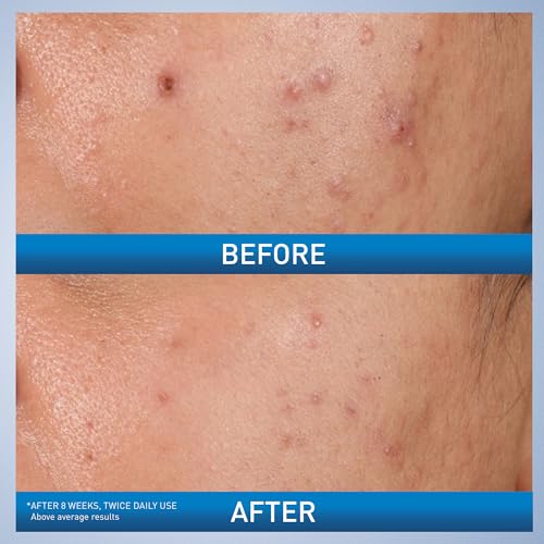CeraVe Acne Control Gel, 2% Salicylic Acid Treatment With Glycolic Acid + Lactic Acids CeraVe