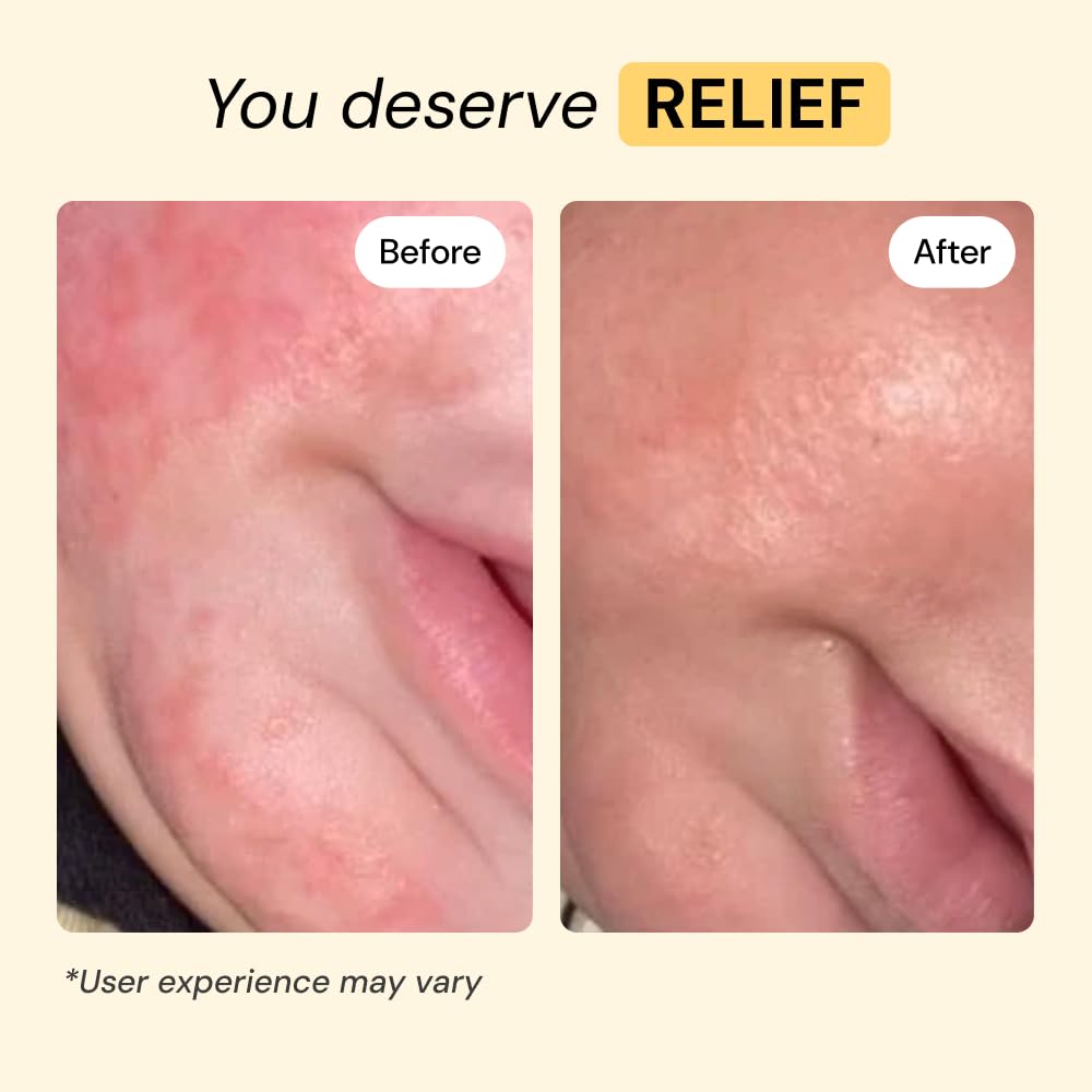 MyMagicHealer Universal Flare Care | Essential Oil Free | Baby Dermatitis, Diaper Rash, Eczema, Psoriasis, Impetigo | Wound Car MyMagicHealer