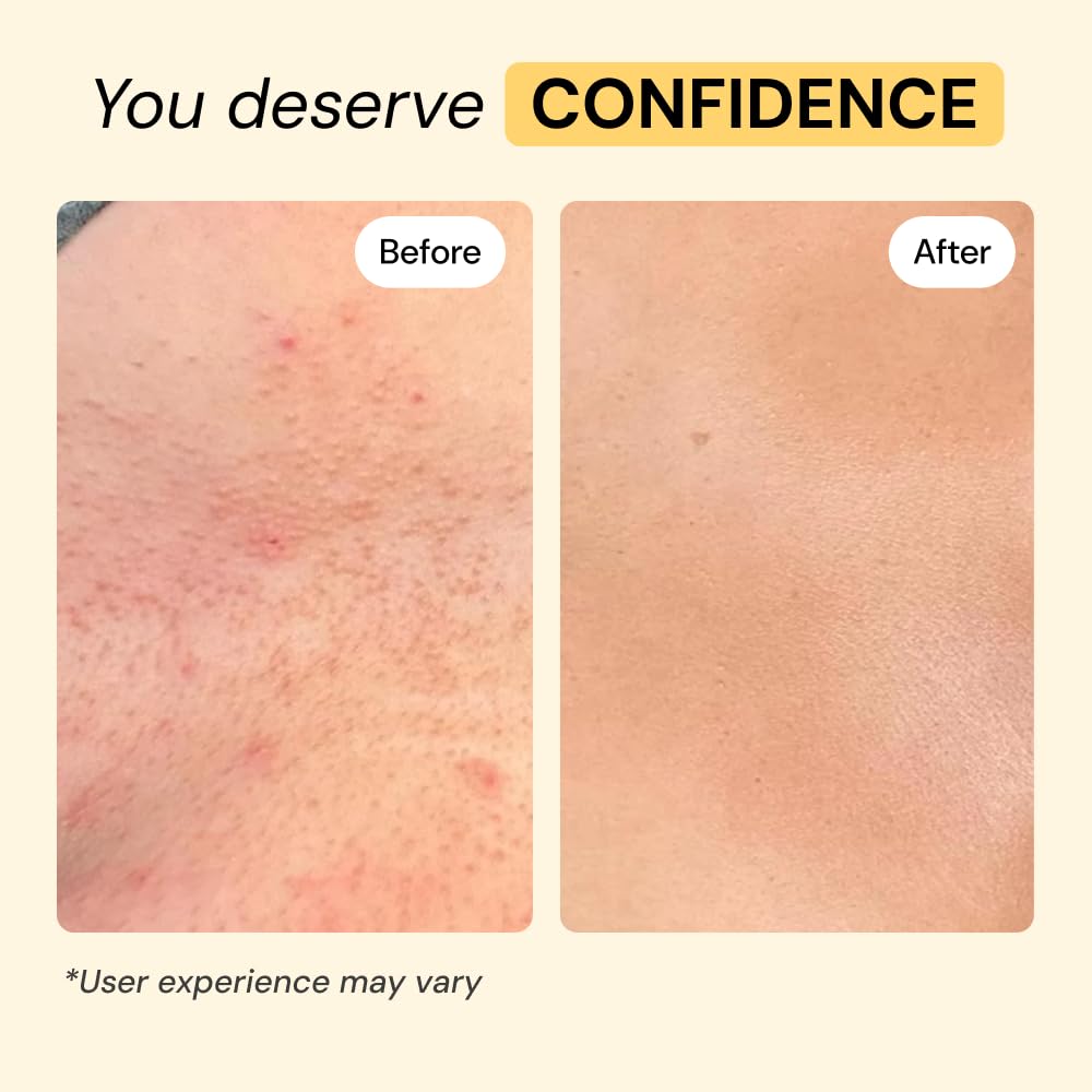 MyMagicHealer Universal Flare Care – Solution for Everyday Skin Flare-Ups | Drawing Salve for Boils & Cysts, Hidradenitis Suppurativa, Folliculitis | Irritated Skin and Chafing Relief 1 oz MyMagicHealer