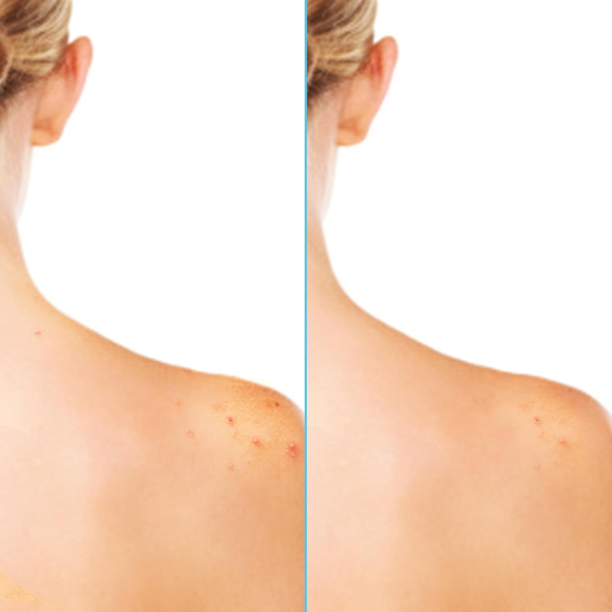 Differin Acne Body Spray, Salicylic Acid Back & Chest Treatment, 6oz Differin