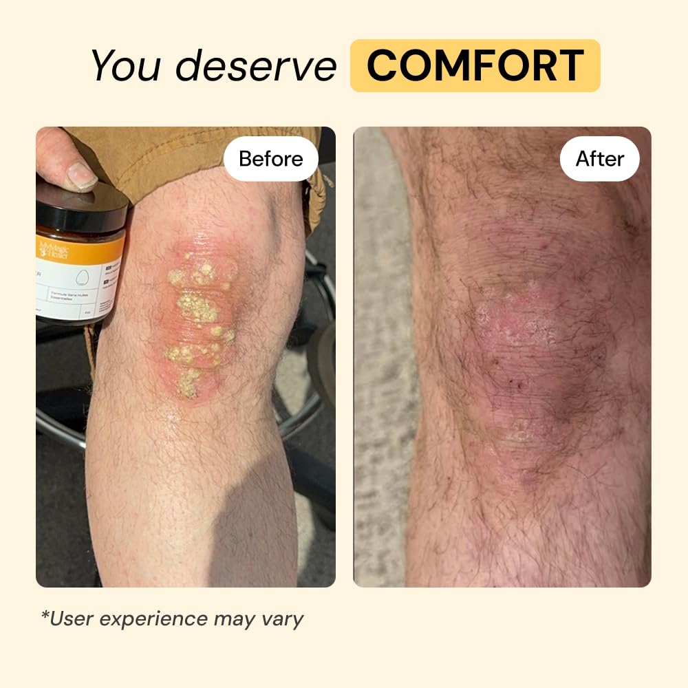 MyMagicHealer Universal Flare Care | Essential Oil Free | Baby Dermatitis, Diaper Rash, Eczema, Psoriasis, Impetigo | Wound Car MyMagicHealer