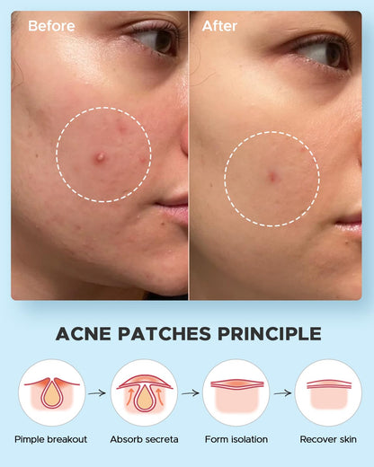 LitBear Acne Pimple Patches- Day and Night 4 Sizes 180 Dots Thin & Thick Hydrocolloid Patches with Witch Hazel, Tea Tree & Calendula Oil, Pimple Stickers for Covering Zits, Spots, Acne Dots LitBear
