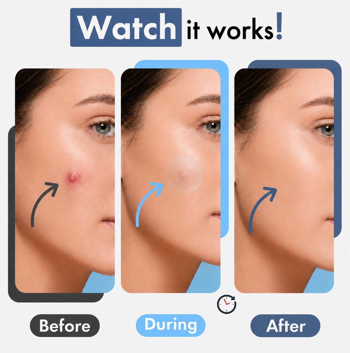 Hellados™ 450 Pimple Patches For Face, 4 Size Hydrocolloid Acne Patches Hellados