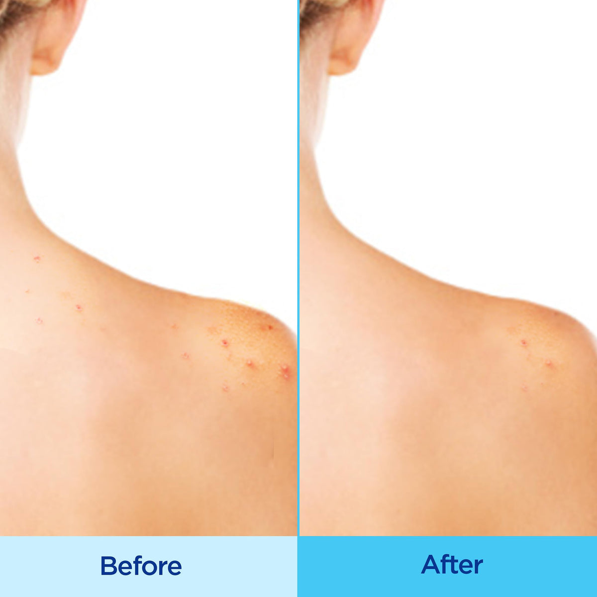 Differin Acne Body Spray, Salicylic Acid Back & Chest Treatment, 6oz Differin