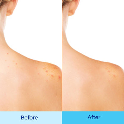 Differin Acne Body Spray, Salicylic Acid Back & Chest Treatment, 6oz Differin
