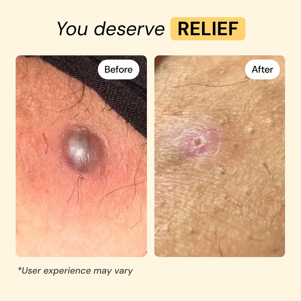 MyMagicHealer Universal Flare Care – Solution for Everyday Skin Flare-Ups | Drawing Salve for Boils & Cysts, Hidradenitis Suppurativa, Folliculitis | Irritated Skin and Chafing Relief 1 oz MyMagicHealer