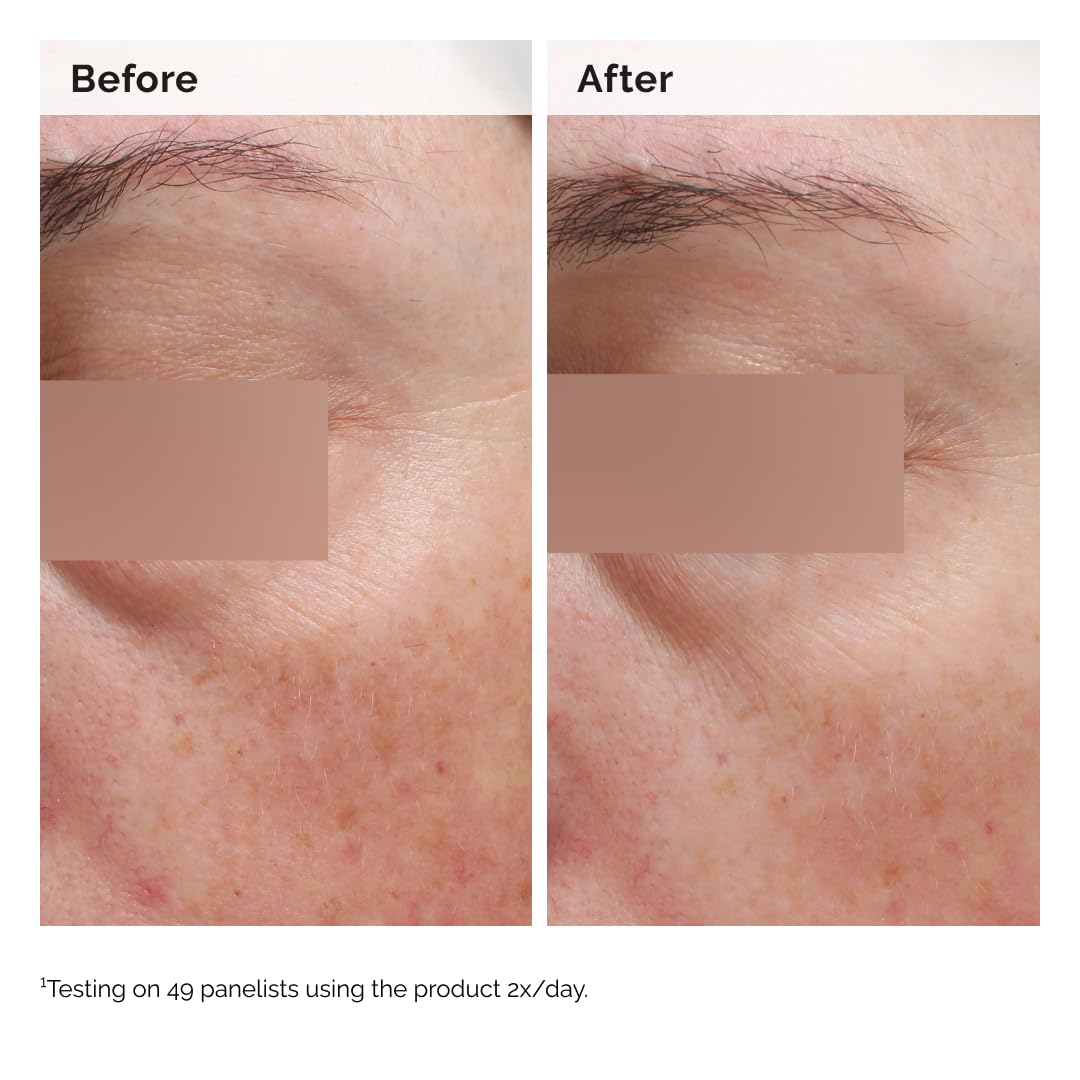 The Ordinary Niacinamide 5% Face and Body Emulsion, Dark Spot & Skin Tone Corrector, 3.4 Fl Oz The Ordinary