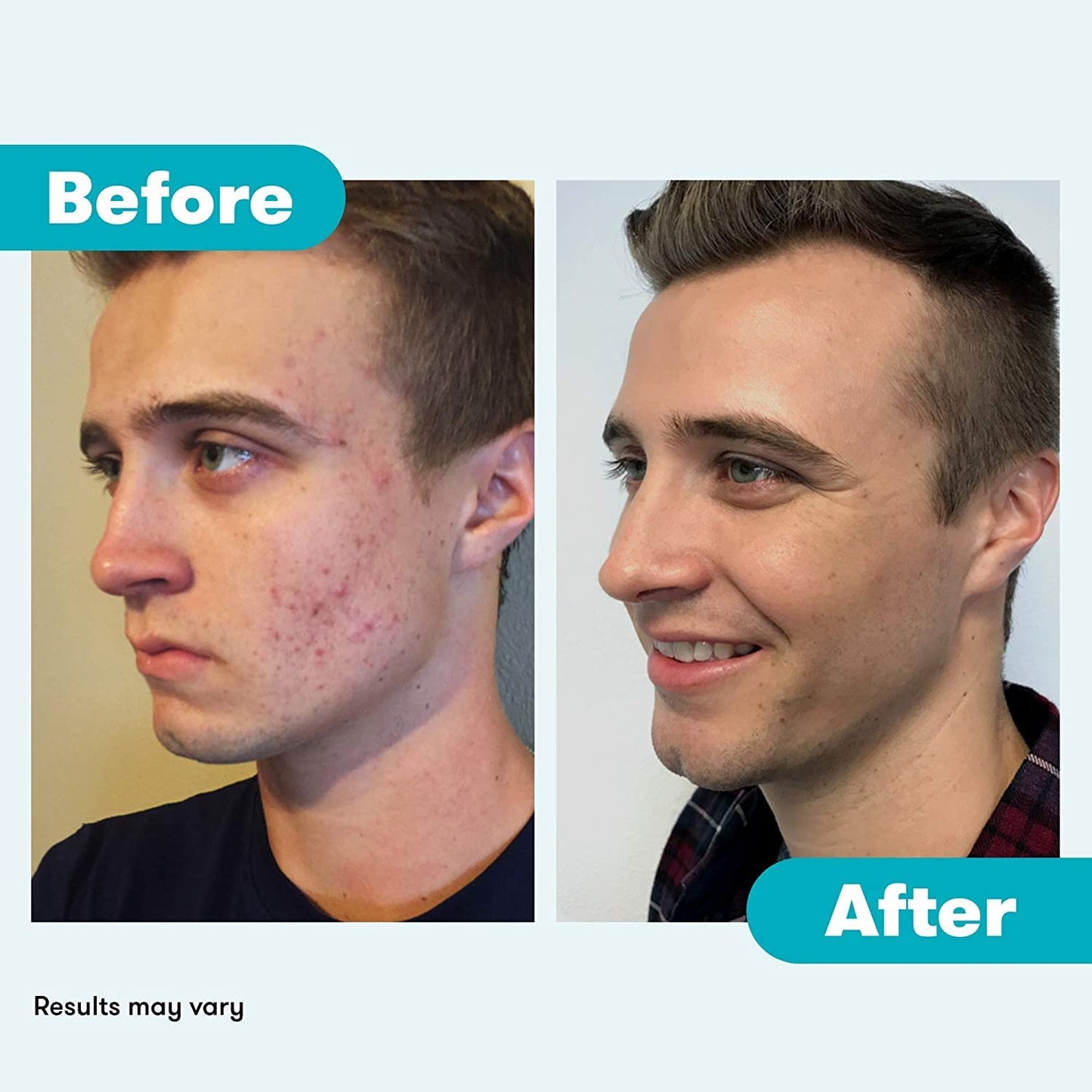 Proactiv Repair Acne Treatment Benzoyl Peroxide Spot Treatment and Repairing Serum Clear, 3 Fl Oz Proactiv