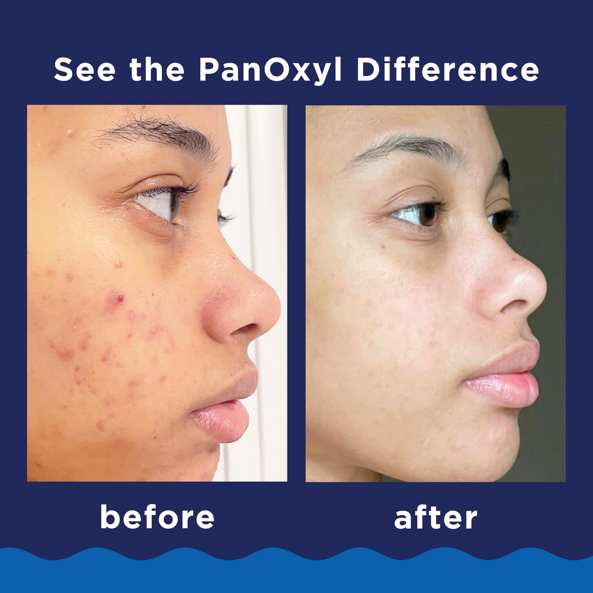 PanOxyl 10% Benzoyl Peroxide Acne Foaming Wash, Maximum Strength, Daily Acne-Fighting Face and Body Cleanser, Face Wash to Clear, Treat and Prevent Acne Pimples and Stubborn Breakouts, 5.5 Oz Tube PanOxyl