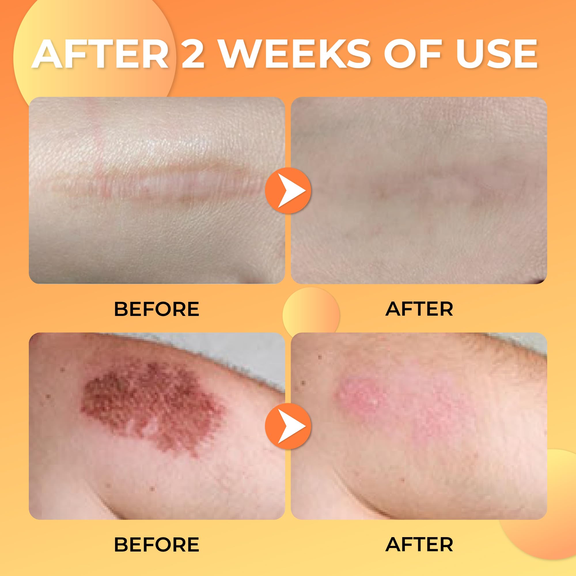 ABERA Scar Removal Cream for Women and Men - Rapid Repair of New Old Scars, Spots, Burns All Natural Treatment with Vitamin E, Alanine, Collagen (1 Box + 3 Eye Patch) ABERA buy australia supplements