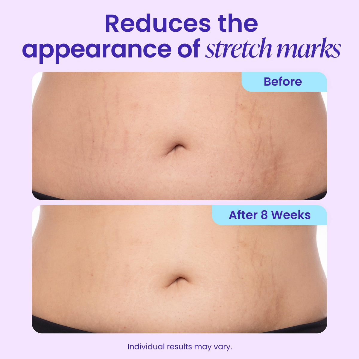 GOPURE Tighten & Smooth Belly Cream - Clinically Tested with MicroTight4 Complex to Reduce the Appearance of Cellulite & Stretch Marks - Quick Absorbing for Smoother, Firmer-Looking Skin, 4.25oz goPure