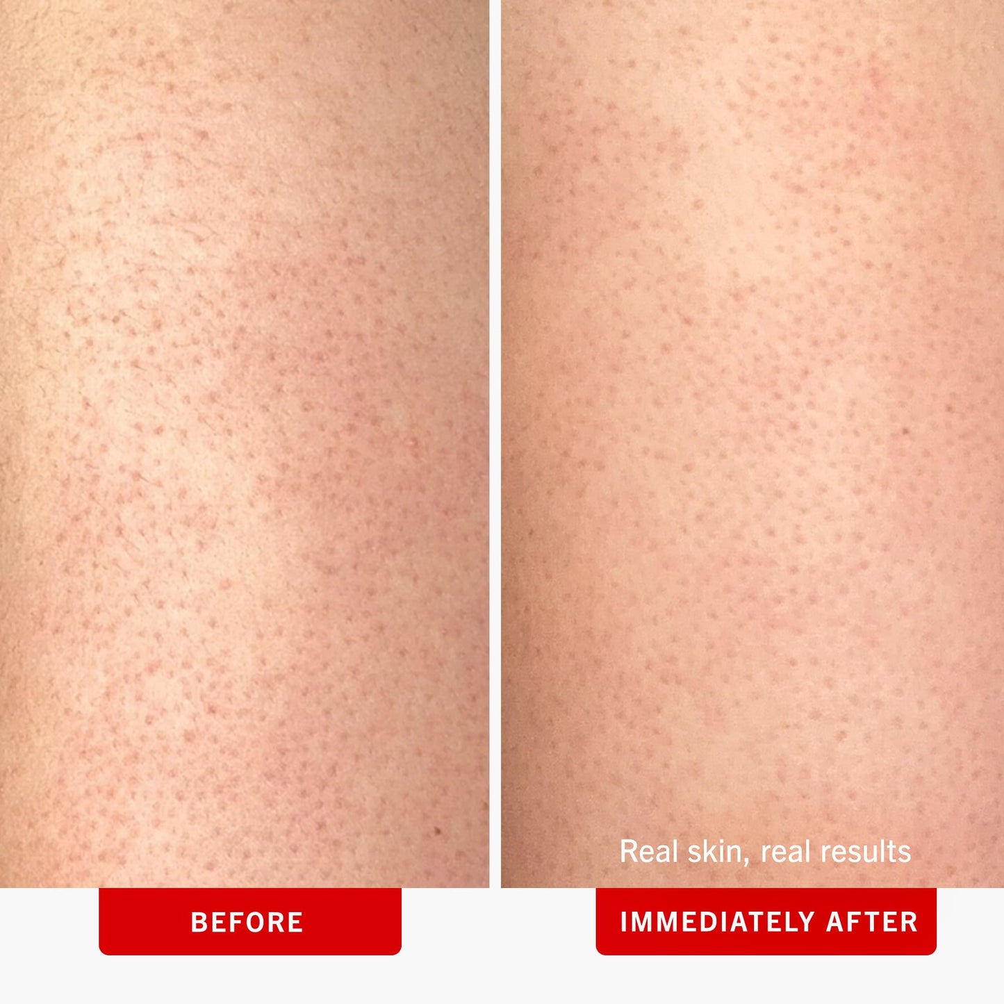 First Aid Beauty - KP Bump Eraser Body Scrub with 10% AHA, Keratosis Pilaris Exfoliator with Glycolic and Lactic acids, Helps Reduce Chicken Skin Bumps First Aid Beauty