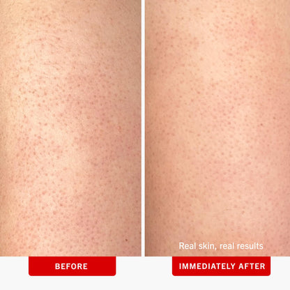 First Aid Beauty - KP Bump Eraser Body Scrub with 10% AHA, Keratosis Pilaris Exfoliator with Glycolic and Lactic acids, Helps Reduce Chicken Skin Bumps First Aid Beauty
