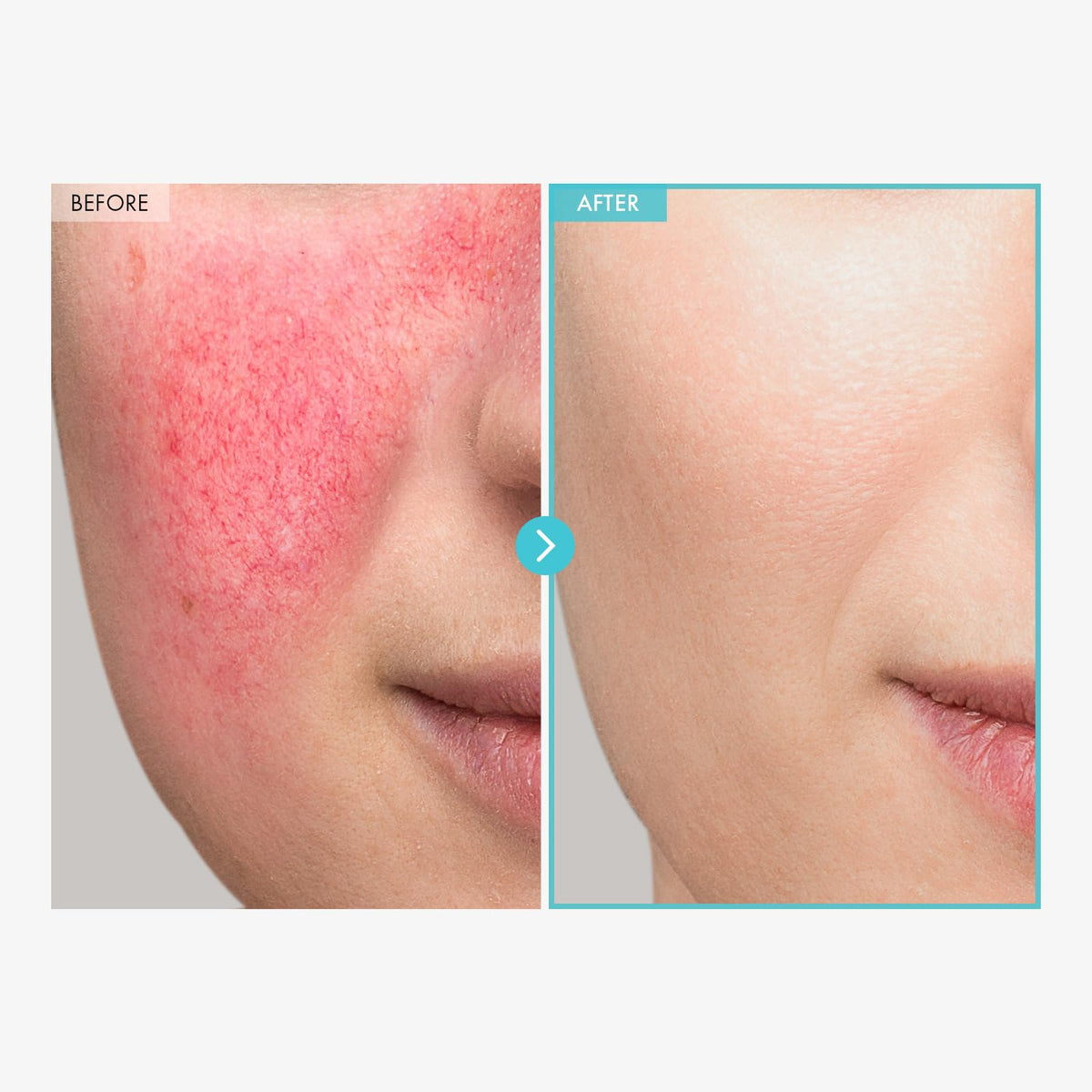 TOSOWOONG Zinc Oxide 10% Cream for Redness & Barrier, Rosacea Treatment TOSOWOONG