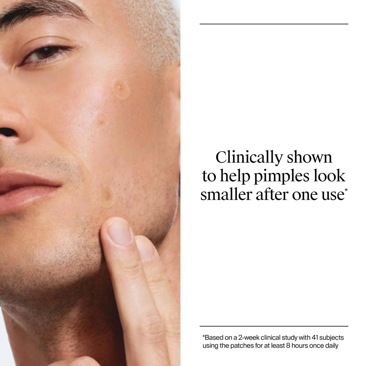Neutrogena Stubborn Acne Patches, Ultra-Thin Pimple Patches, 24 Ct Neutrogena