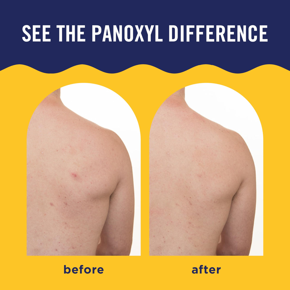PanOxyl Acne Banishing Body Spray, 2% Salicylic Acid, For Body, 6 oz PanOxyl