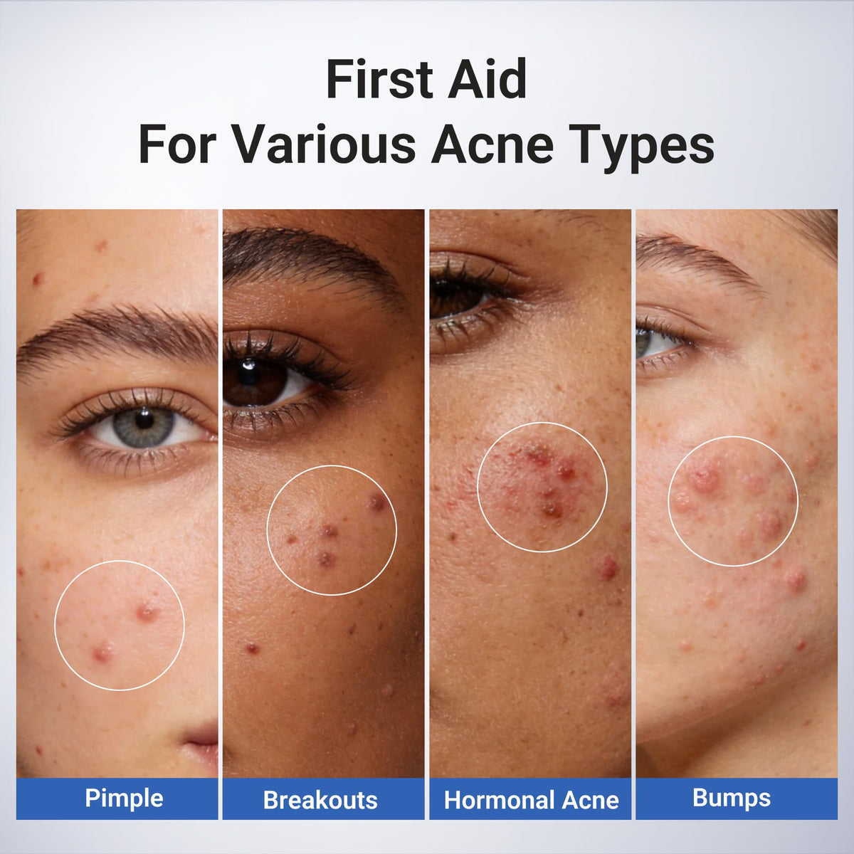 Dr.Leo 1.8% Salicylic Acid Acne Spot Treatment Drying Lotion, 0.34oz Dr.Leo
