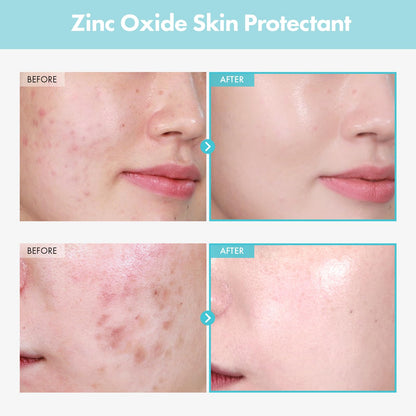 TOSOWOONG Zinc Oxide 10% Cream for Redness & Barrier, Rosacea Treatment TOSOWOONG
