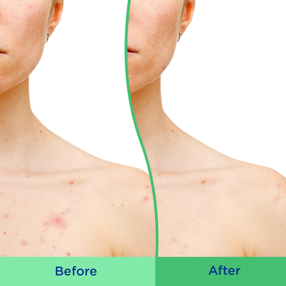 Differin Acne Body Scrub, Salicylic Acid for Back & Chest Treatment, 8oz Differin