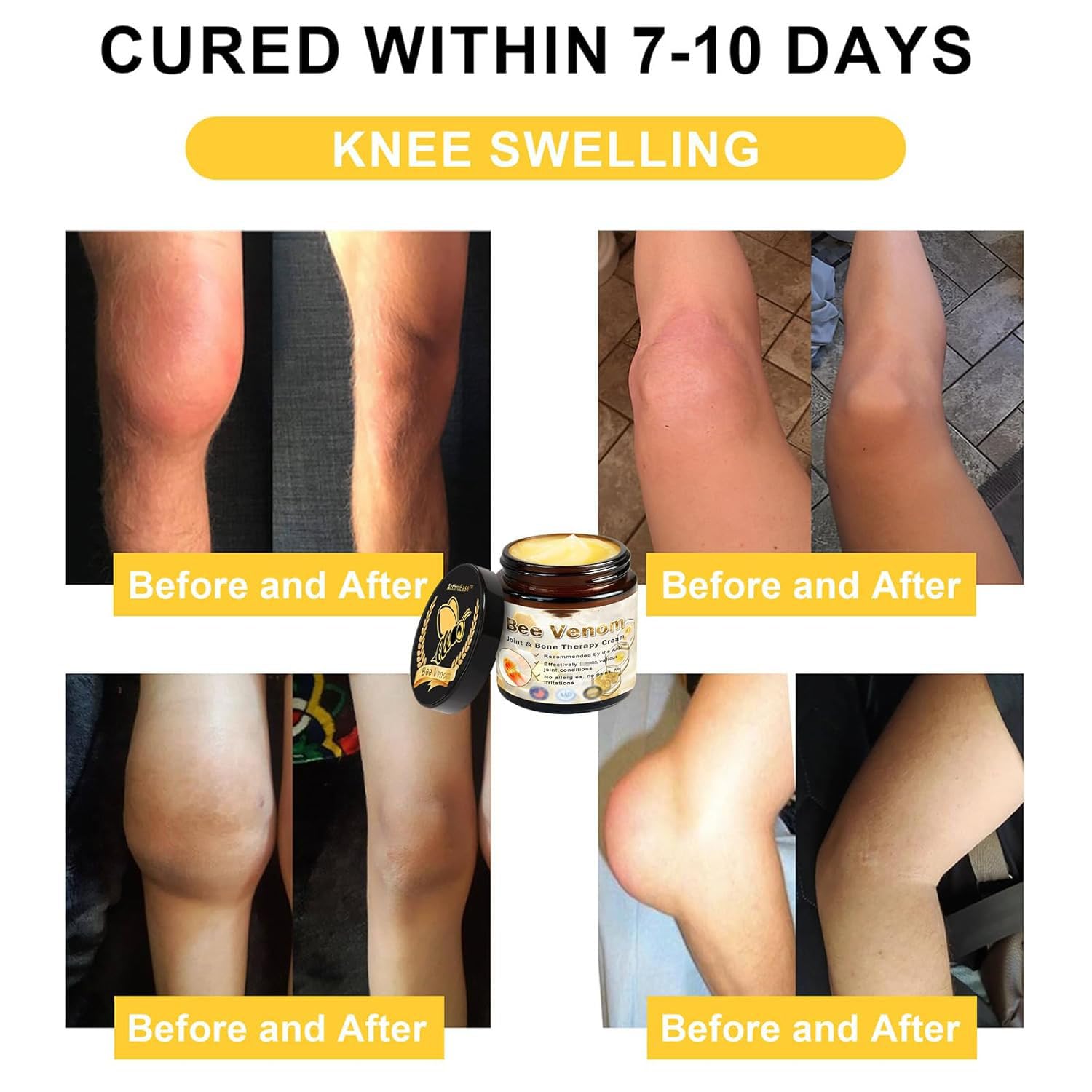 ArthroEase Bee Venom Arthritis Cream, Joint & Muscle Soothing Bee Venom Cream, Professional Bee Venom Joint Cream, Bee Venom Joint Gel - Specially for for Back, Neck, Hands, Knee (2 Bottle) Lmoy buy australia supplements