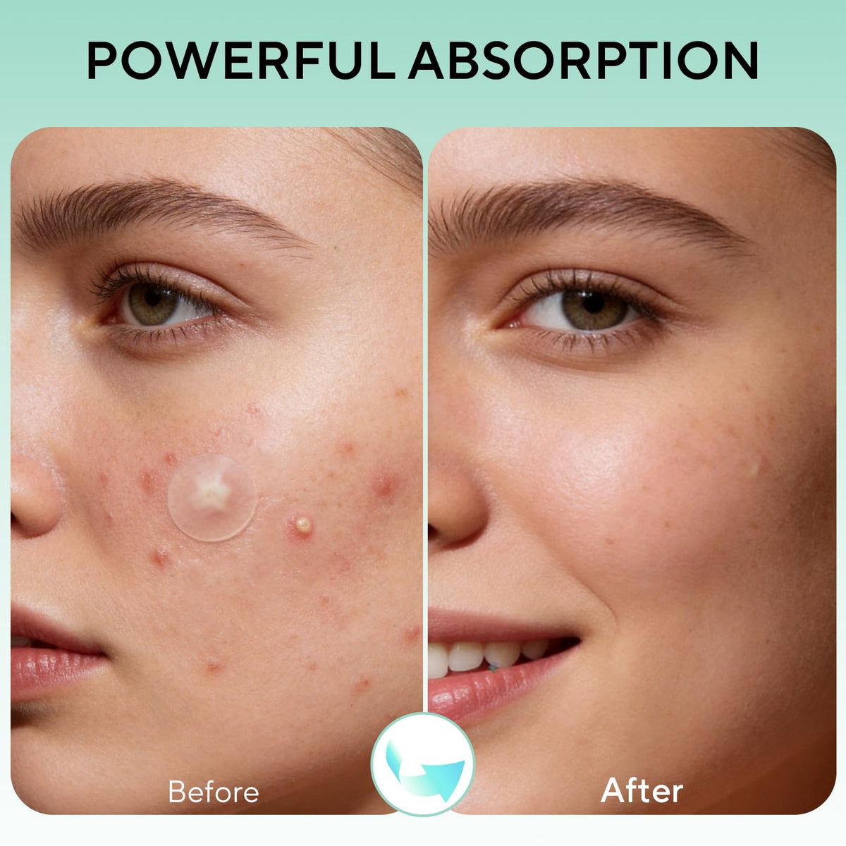 QUSTERE 580 Count Pimple Patches for Face, Large Hydrocolloid Acne Patches Stickers Bandages, Blemishes Zit Breakouts for Cheeks, Forehead, Chin, Nose for Full Face & Body | 7 Sizes | 4 Shapes QUSTERE