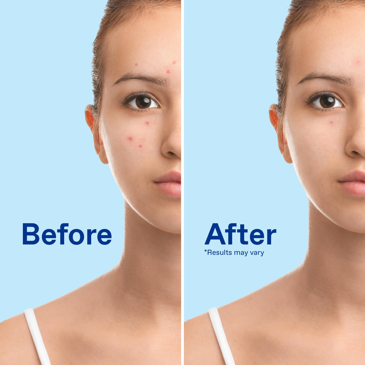 Differin Acne Foaming Face Wash, Max Strength, 10% Benzoyl Peroxide, 5oz Differin