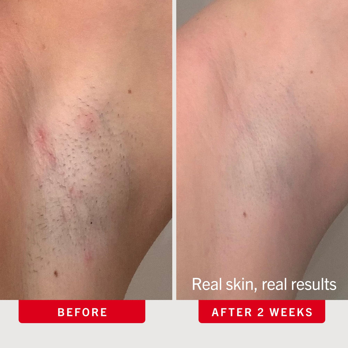 First Aid Beauty Ingrown Hair Pads with BHA and AHA, 28 ct First Aid Beauty