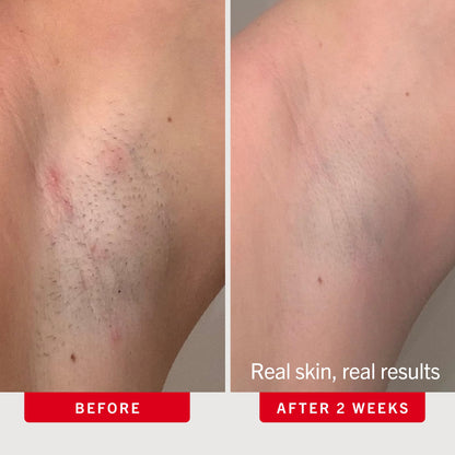 First Aid Beauty Ingrown Hair Pads with BHA and AHA, 28 ct First Aid Beauty