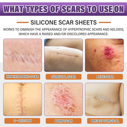 Silicone Scar Sheets,Silicone Scar Tape,Silicone Scar Removal Strips for Surgical,C-Section,Tummy Tuck,Keloid Scars Psecici