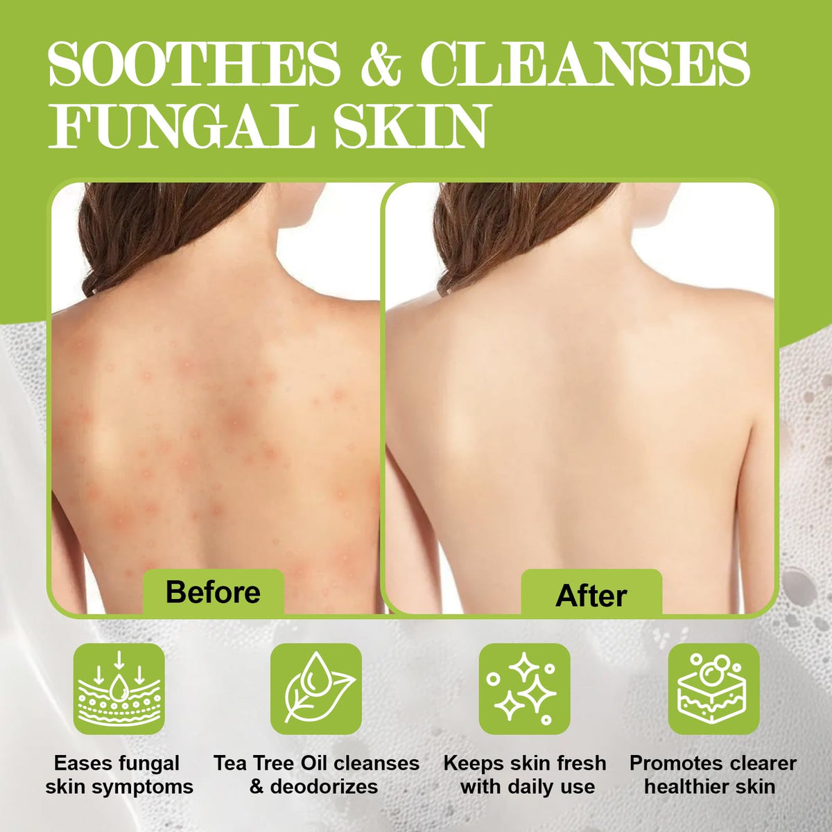 Antifungal Soap-Antibacterial Soap Bar with Tea Tree Oil (3Bars x 2.82oz) NXPPYY