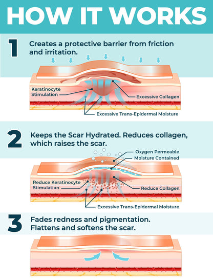 Medical Grade Silicone Scar Tape - 1.6"x150" - Effective Scar Removal MYHELP