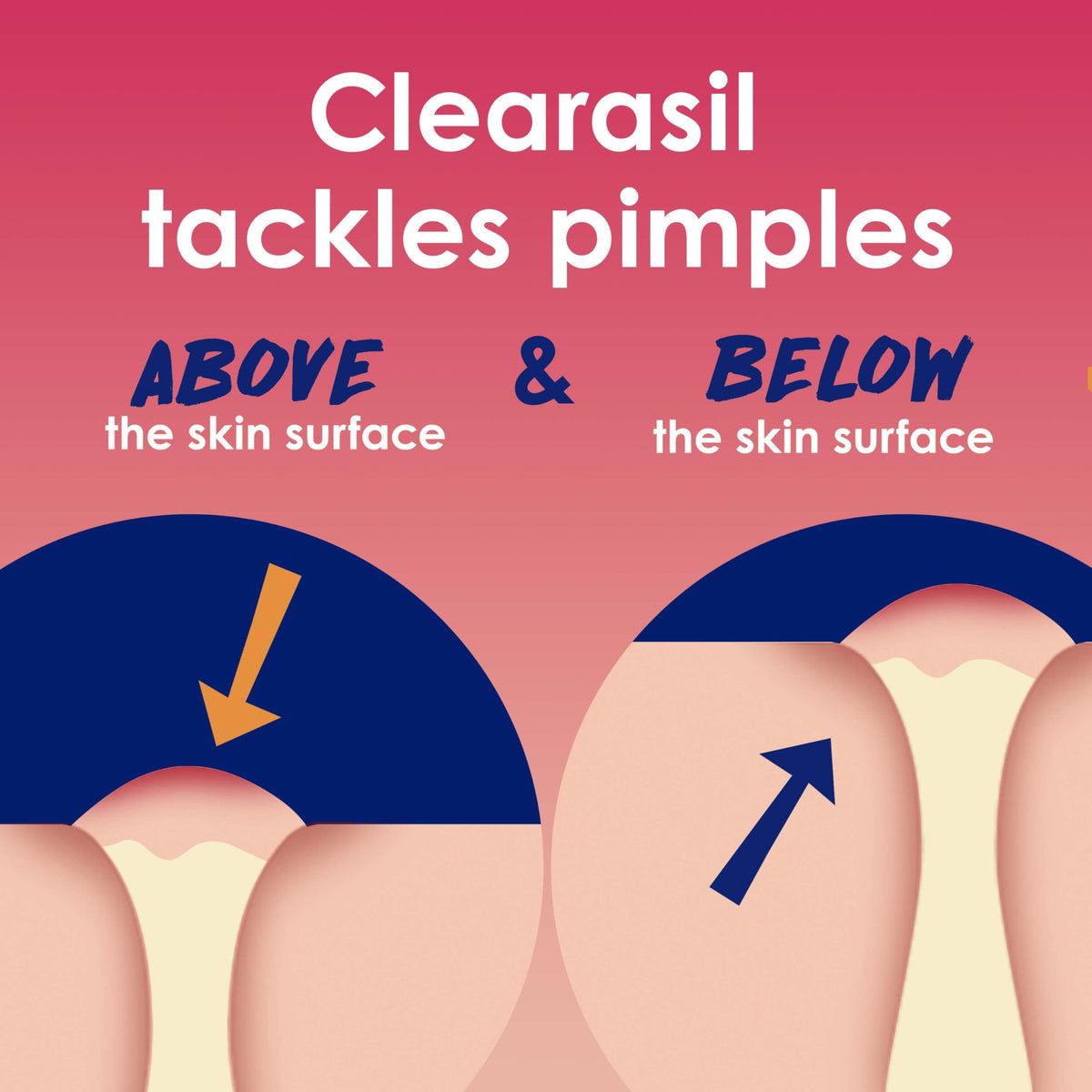 Clearasil Rapid Rescue Deep Treatment Acne Face Pads, Maximum Strenght with 2% Salicylic Acid Acne Treatment Medicine, 90 Count Clearasil