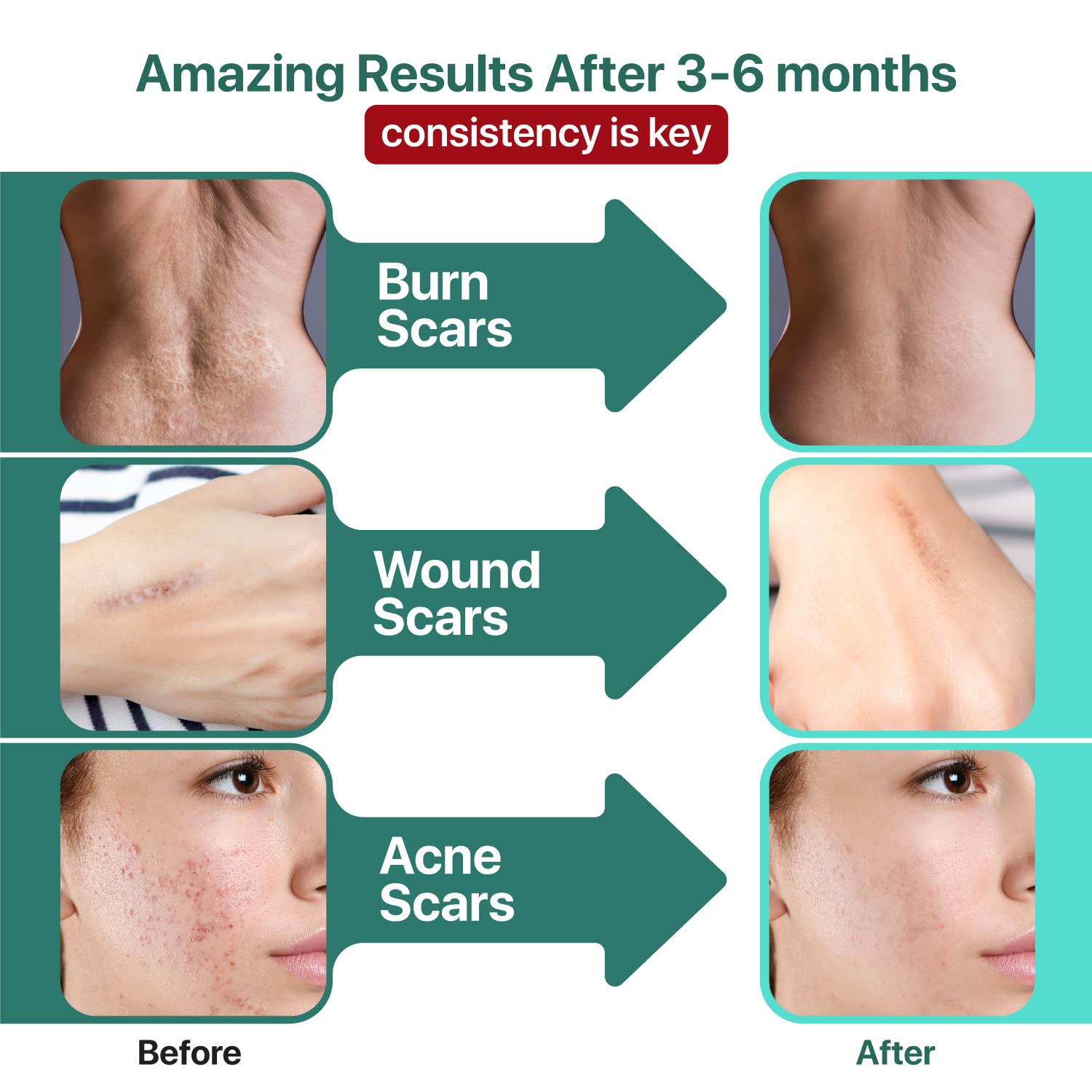 Ebanel Bundle of Advanced Silicone Scar Gel 1 Oz, and Hyaluronic Acid Serum Ebanel buy australia supplements