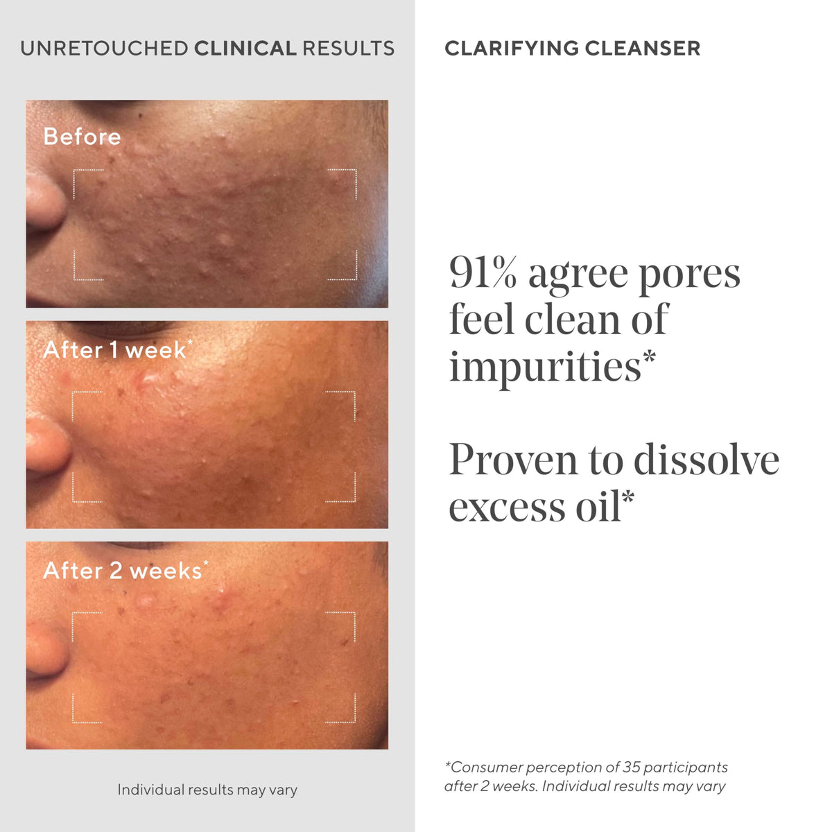 Murad Acne Control Clarifying Cleanser - Salicylic Acid - 5 Fl Oz Murad