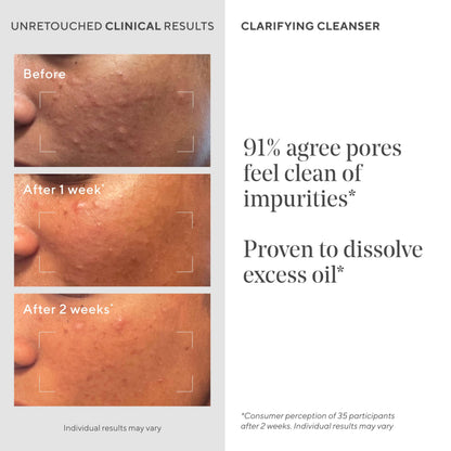 Murad Acne Control Clarifying Cleanser - Salicylic Acid - 5 Fl Oz Murad