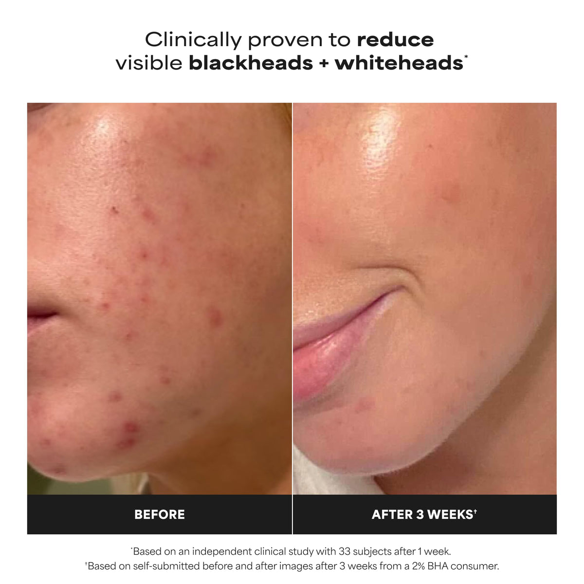 Paula's Choice SKIN PERFECTING 2% BHA Liquid Exfoliant, 4 Fl Oz Paula's Choice