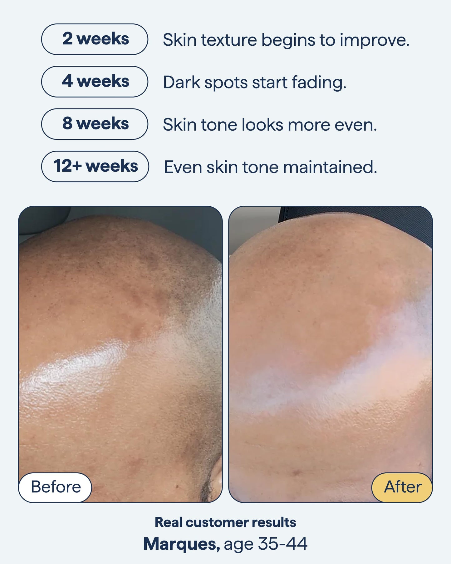 Remedy for Dark Spots | Advanced Night Treatment with Retinol & Kojic Acid | For Discoloration and Uneven Tones | With Glutathione Remedy Science