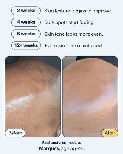 Remedy for Dark Spots | Advanced Night Treatment with Retinol & Kojic Acid | For Discoloration and Uneven Tones | With Glutathione Remedy Science