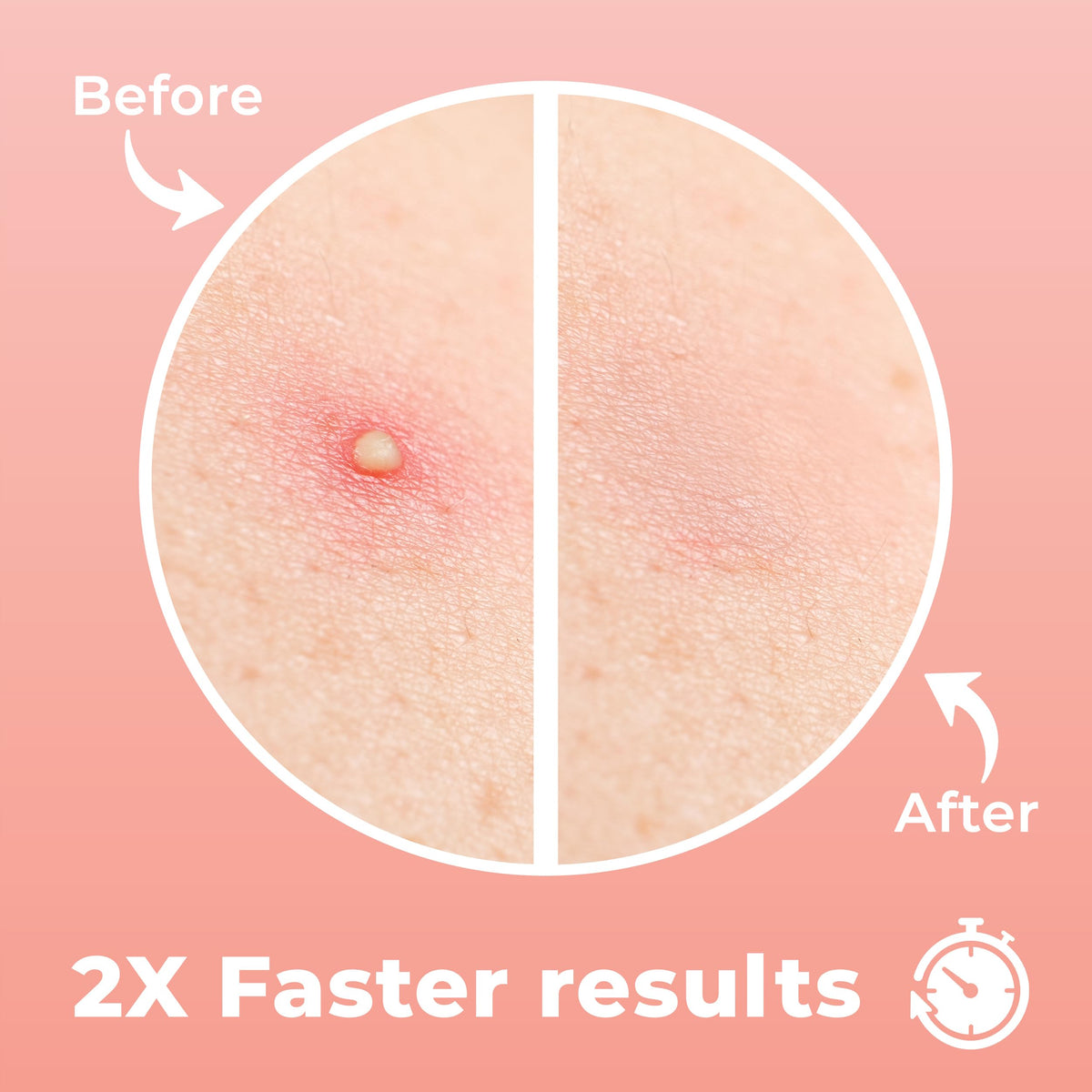 PatchRx Micro Needle Pimple Patch (18 Pack) - Hydrocolloid Micropoint Pimple Patch For Acne & Pimples, Microdart Patch, Micro Dart Pimple Patches PatchRx