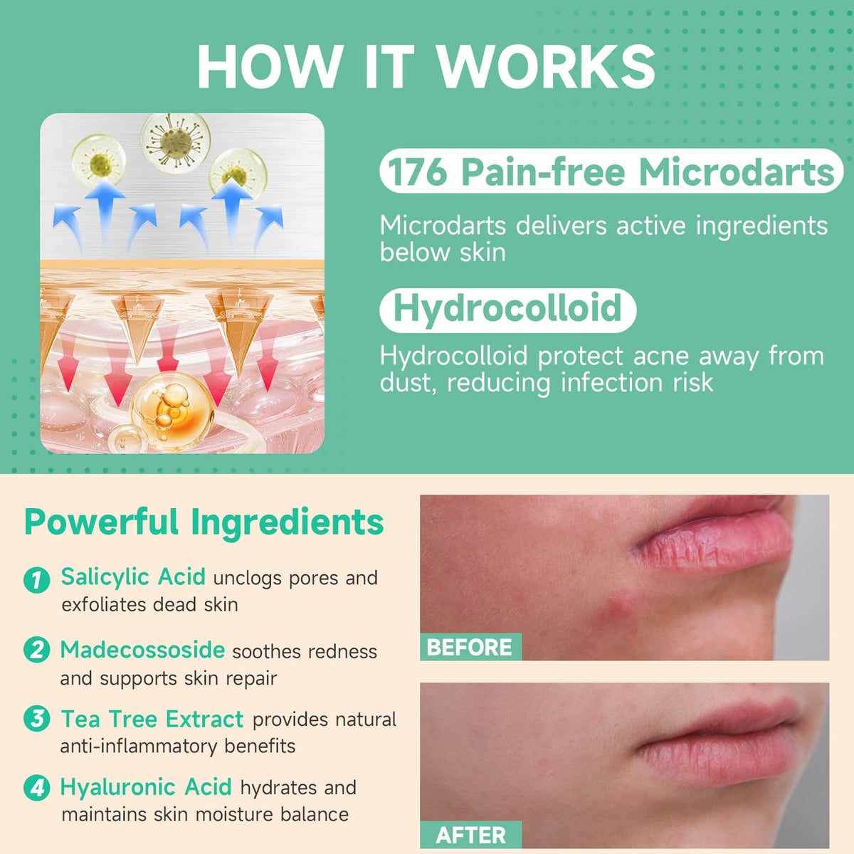 TEAWOO 36-Count Microdart Pimple Patches, Hydrocolloid Acne Patches with Salicylic Acid & Madecossoside, Microdart Zit Patches for Deep Blemishes & Early Stage Acne (Patented) TEAWOO