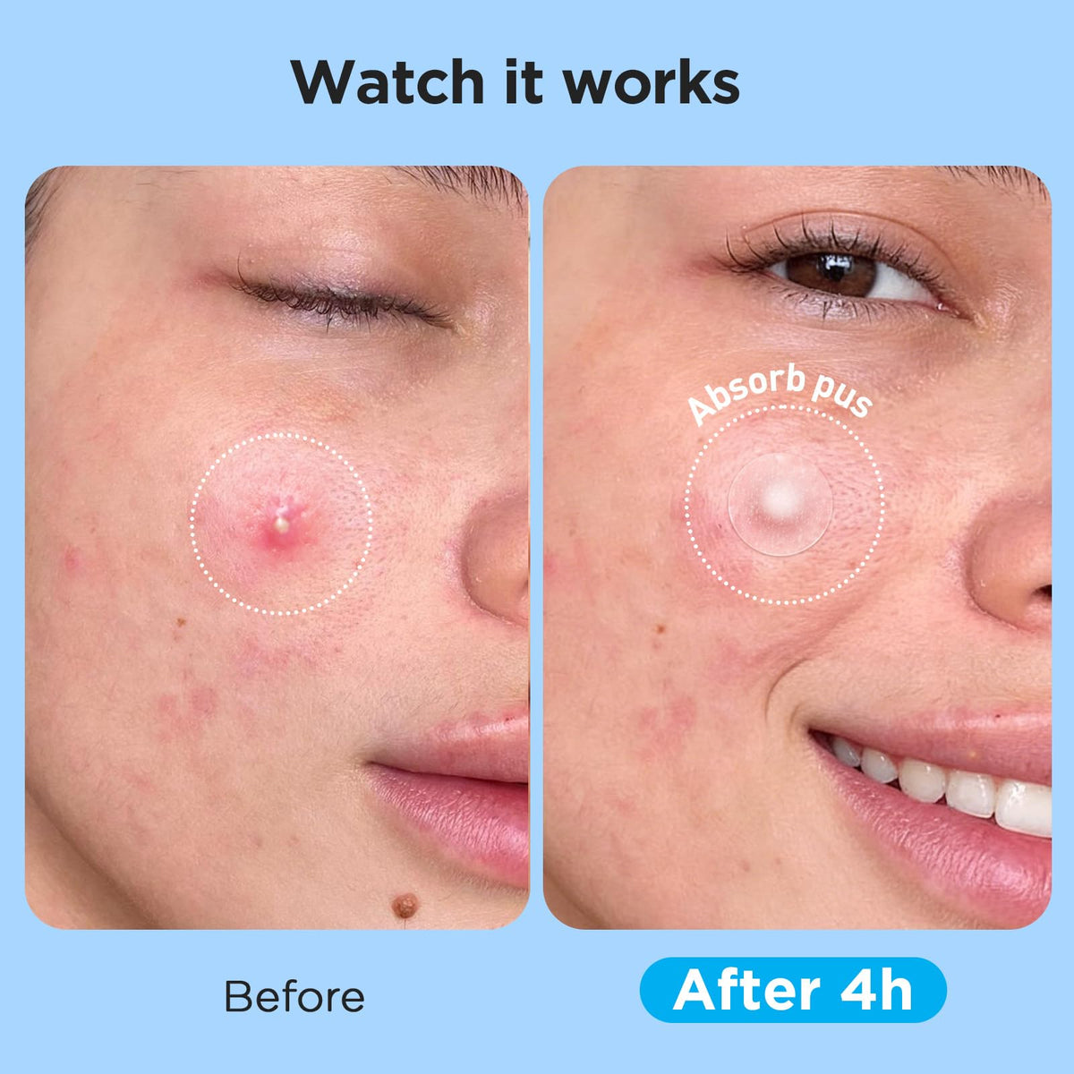 Glowpatch 504 Counts 4 Sizes Hydrocolloid Pimple Patches for Face Glowpatch