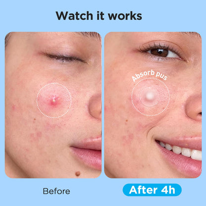Glowpatch 504 Counts 4 Sizes Hydrocolloid Pimple Patches for Face Glowpatch