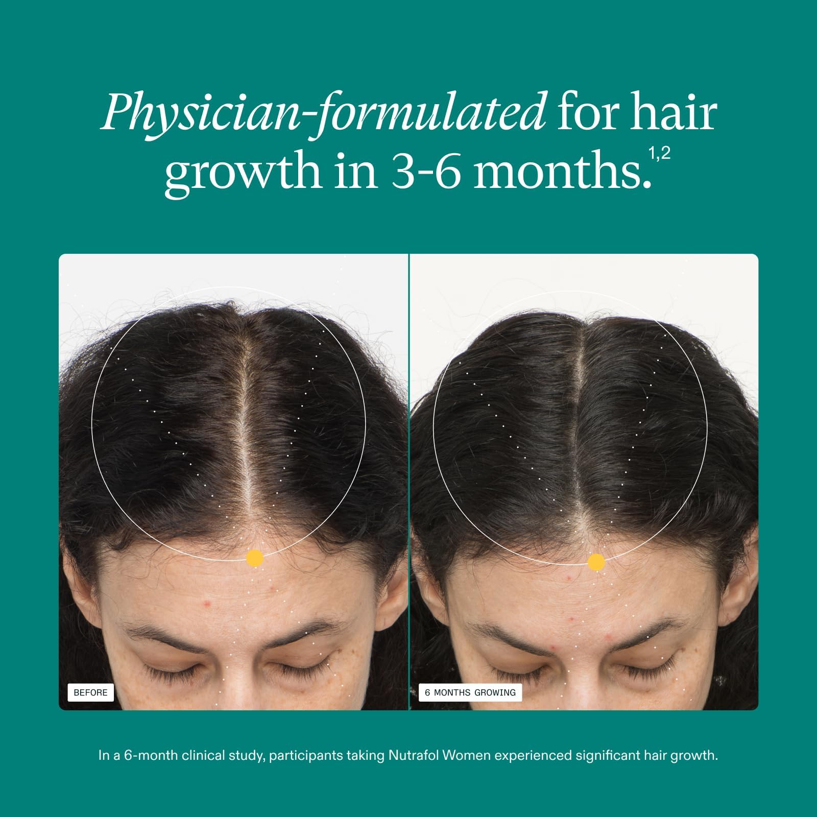 Nutrafol Women's Hair Growth Supplements, Ages 18-44, Clinically Proven for Visibly Thicker and Stronger Hair, Dermatologist Recommended - 1 Month Supply Nutrafol buy australia supplements