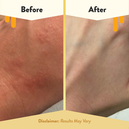 ECZEMA HONEY Oatmeal Body Lotion, Natural Dry Skin Repair (16 Oz) ECZEMA HONEY