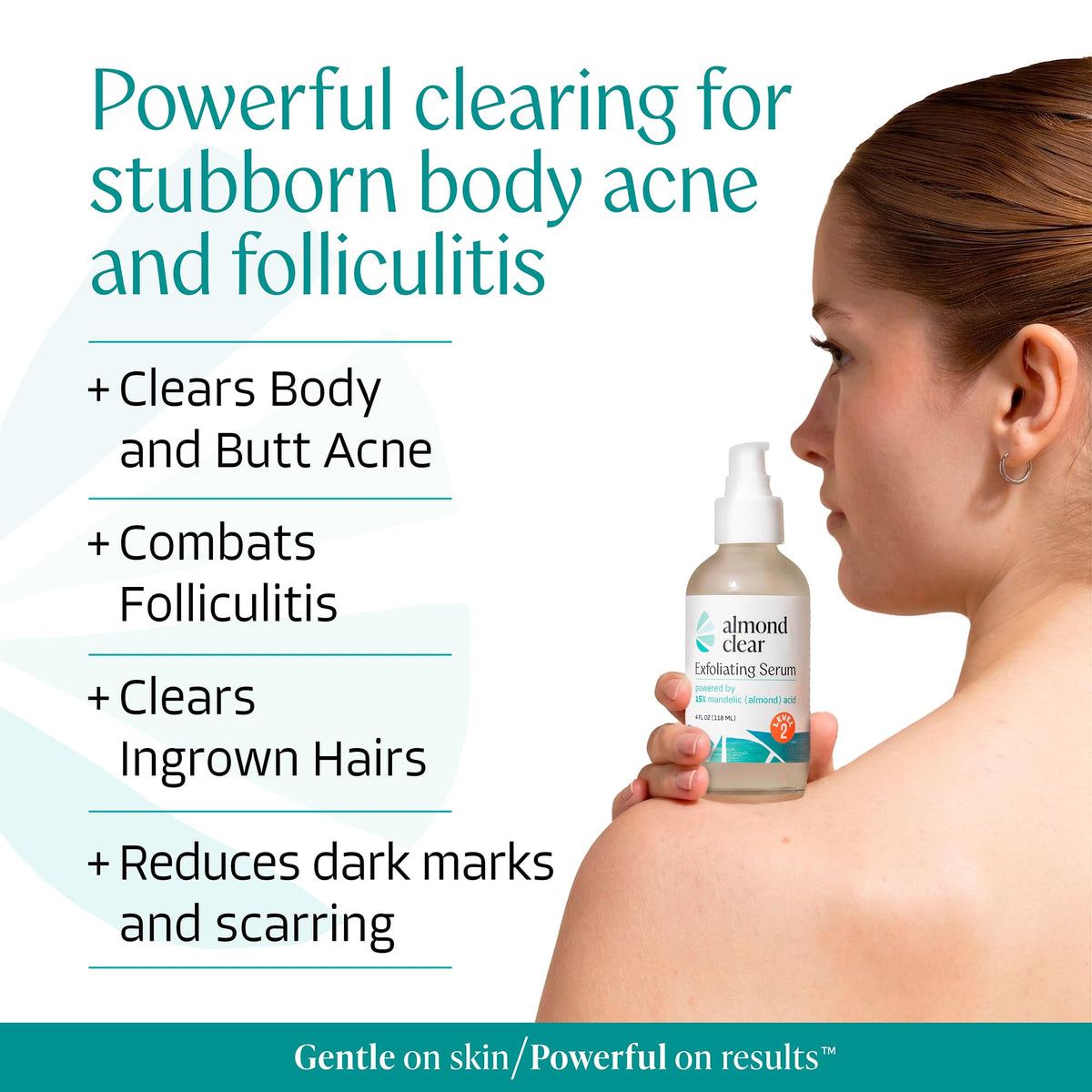Almond Clear Mandelic Acid Level 2 Serum – Extra Strength Treatment for Body Acne, Folliculitis, and Ingrown Hairs – Buttocks Clearing Dark Spot Remover – 1 Fl Oz Almond Clear