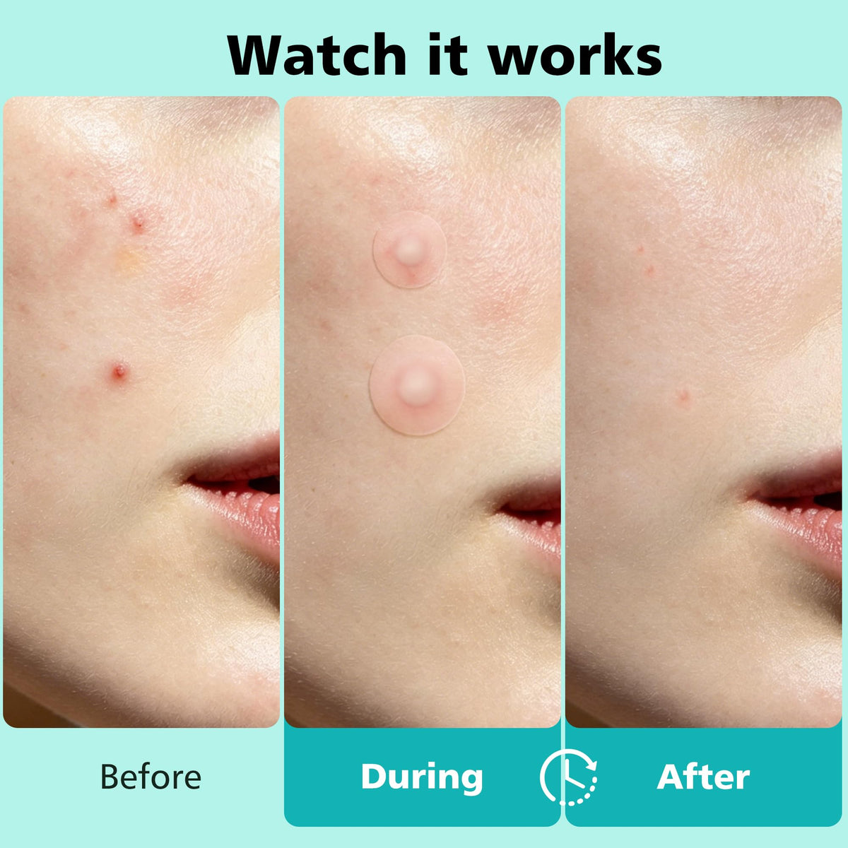Dr.patch 563 Count Pimple Patches - Hydrocolloid Acne Patches for Face & Body, Invisible Thin, Large & Small Sizes for Whiteheads, Zits & Breakouts (Dots, Strip, Contoured 6 Sizes) Dr.patch