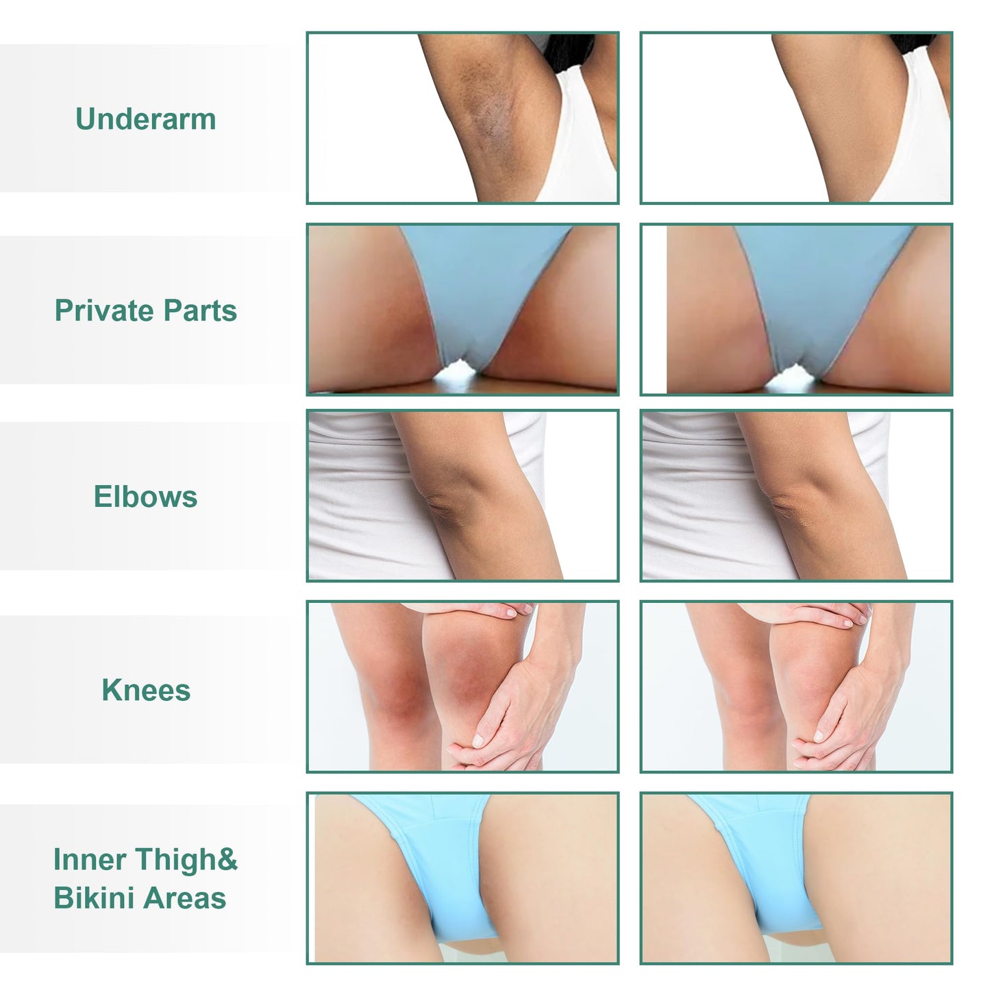 Vcetree Skin Bleaching Cream Skin Lightening for Body Intimate Areas, Private Parts, Underarm, Knees, Elbows, Inner Thigh, Bikini Area Vcetree