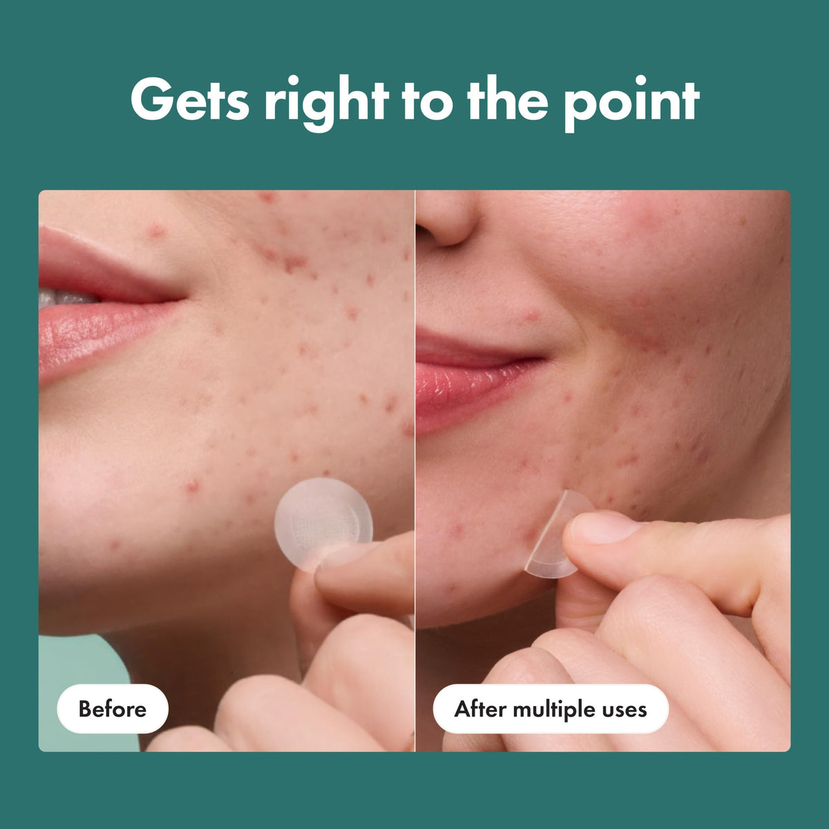 Mighty Patch Hero Cosmetics Micropoint Acne Pimple Patches, 8 Ct Mighty Patch