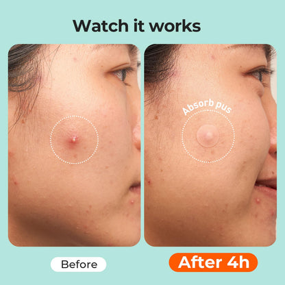 TKTK 443 Count Pimple Patches for Face, Hydrocolloid Acne Cover Patch Bulk TKTK
