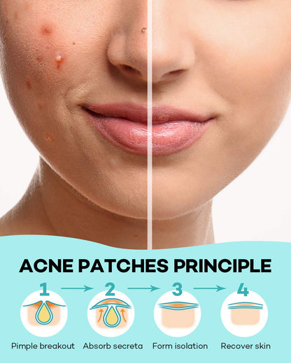 TKTK Pimple Patch for Face, Hydrocolloid Acne Absorbing Dots, 4 Sizes 140CT TKTK